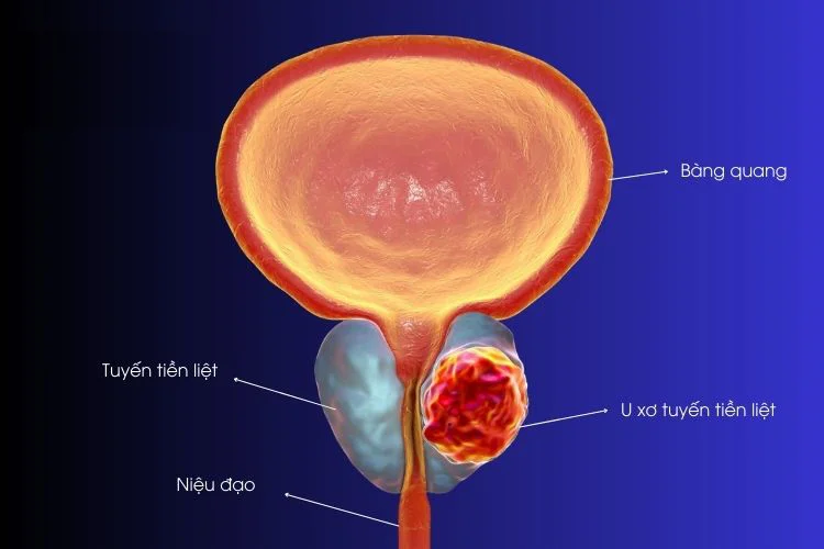 Ung thư tuyến tiền liệt